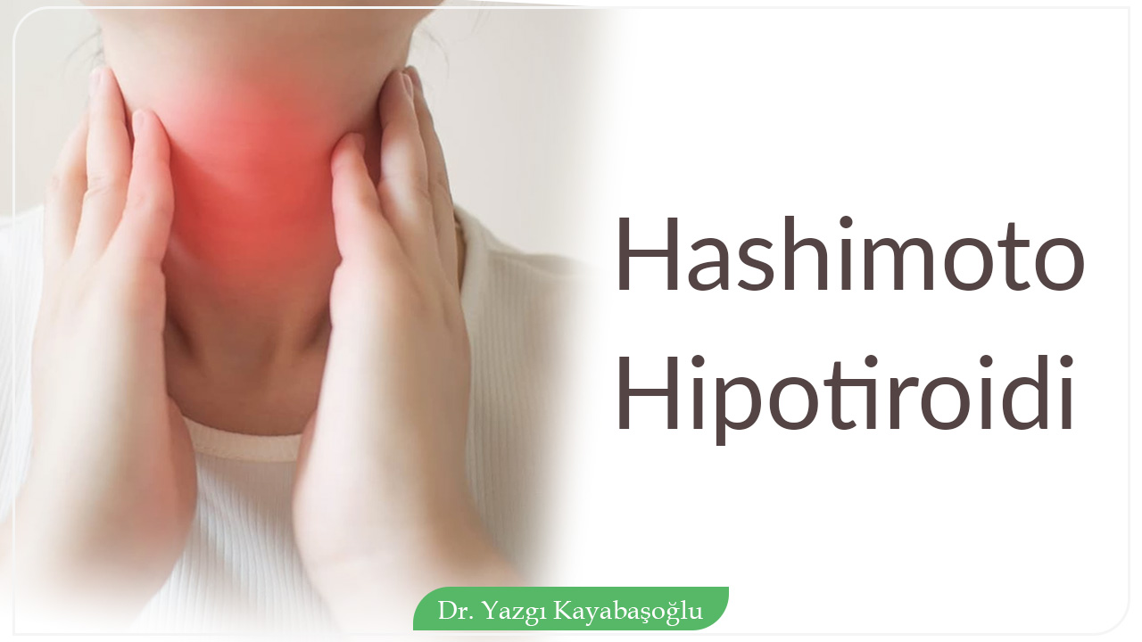 Hashimoto Hipotiroidi