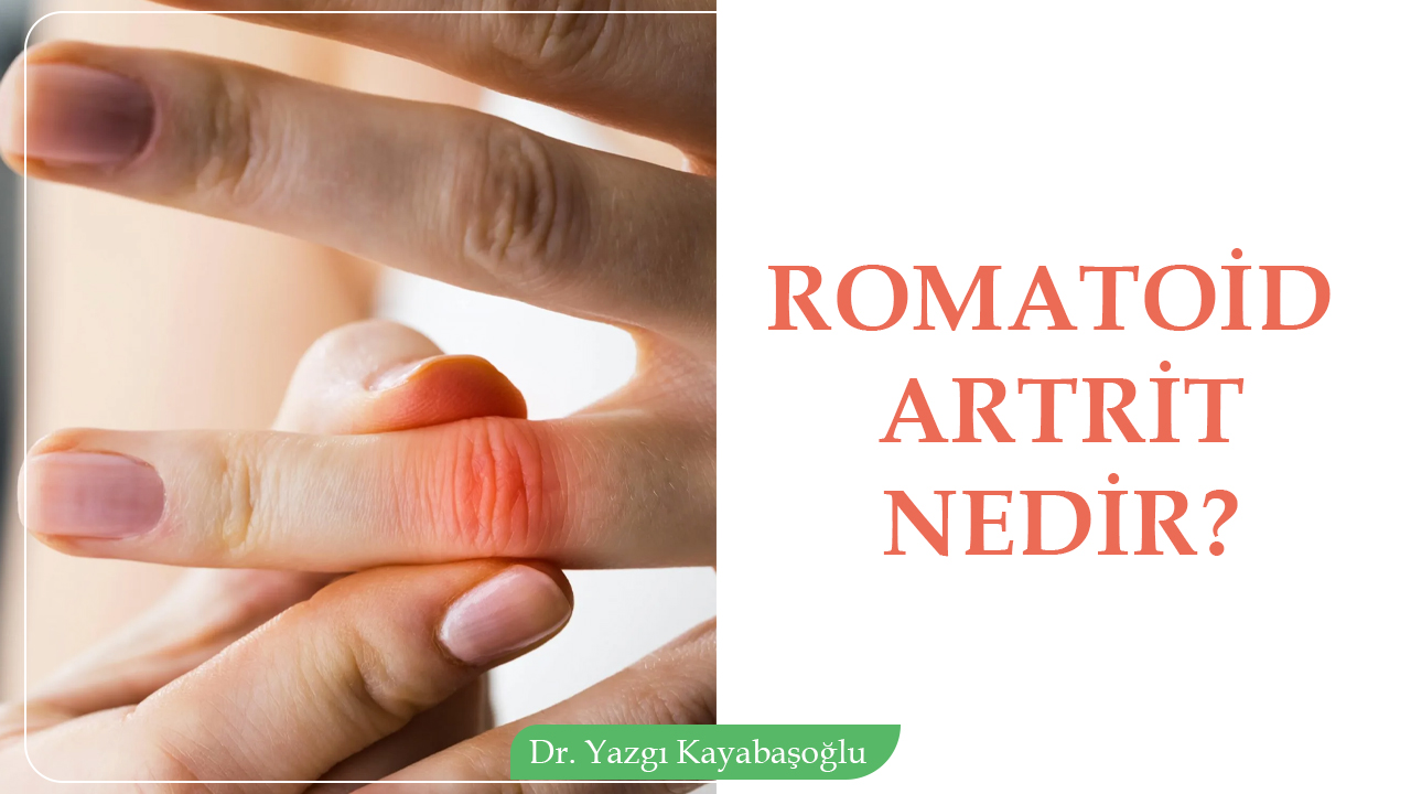 Romatoid Artrit Nedir?